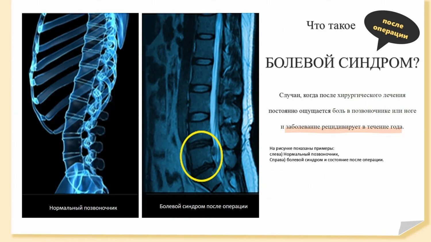 Почему болит позвоночник после операции