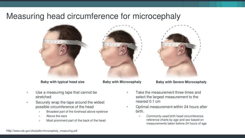 Measuring head. Вирус зика микроцефалия. микроцефалия презентация. head circumference for age. measuring head circumference.