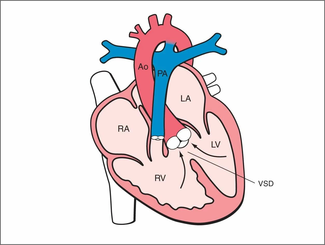 Ventricular Septal defect VSD. Гемодинамика тетрады Фалло. ДМЖП гемодинамика. Дефект межжелудочковой перегородки. Гемодинамика у детей