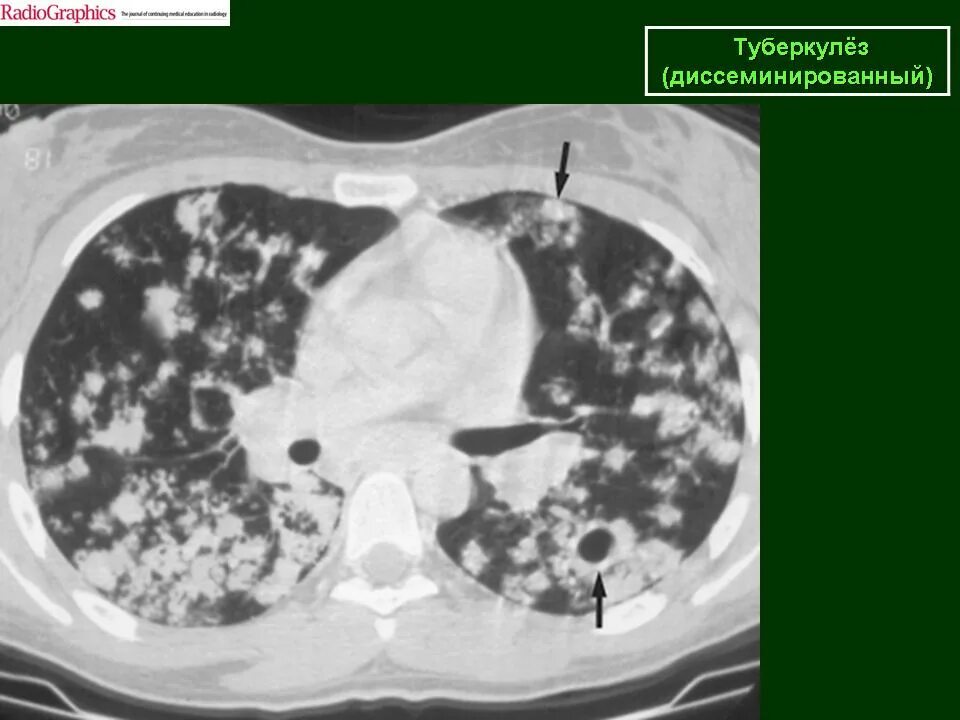 Лимфогенный туберкулез. Диссеминированный туберкулез на кт. Лимфогенно диссеминированный туберкулез кт. Милиарный туберкулез кт. Лимфогенный туберкулез легких на кт.