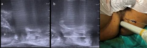 Prostate Cancer and Prostatic Diseases - Sectoral cancer detection and tole...