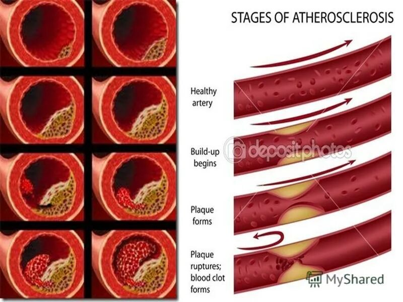 Артерий атеросклероз латынь