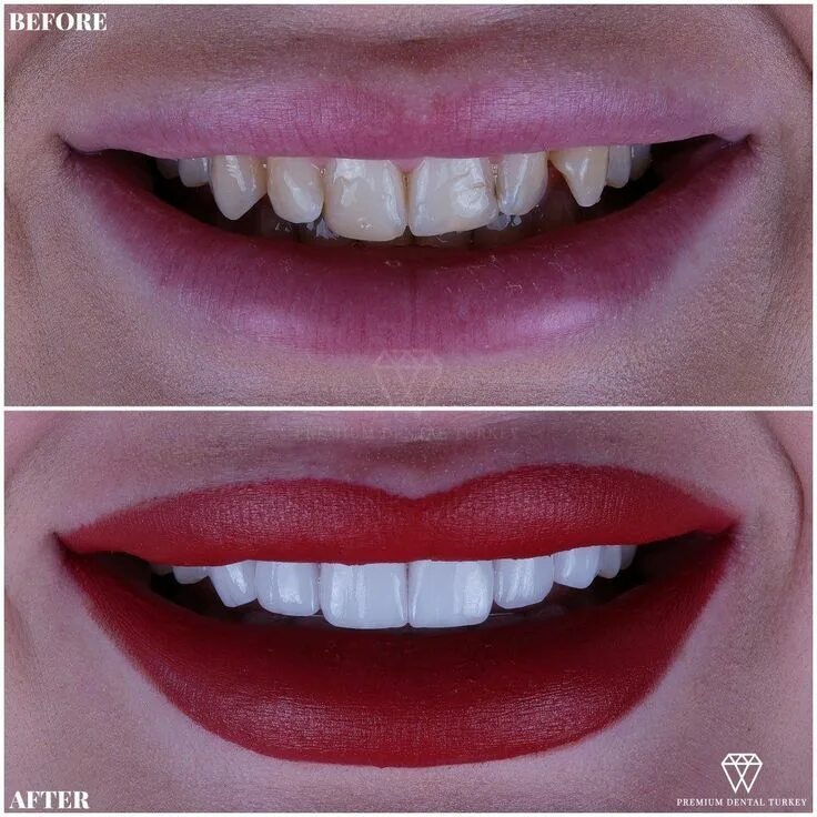 Сделать зубы быстро. Premium dental. где дешевле сделать зубы. как белье сделать зубы.