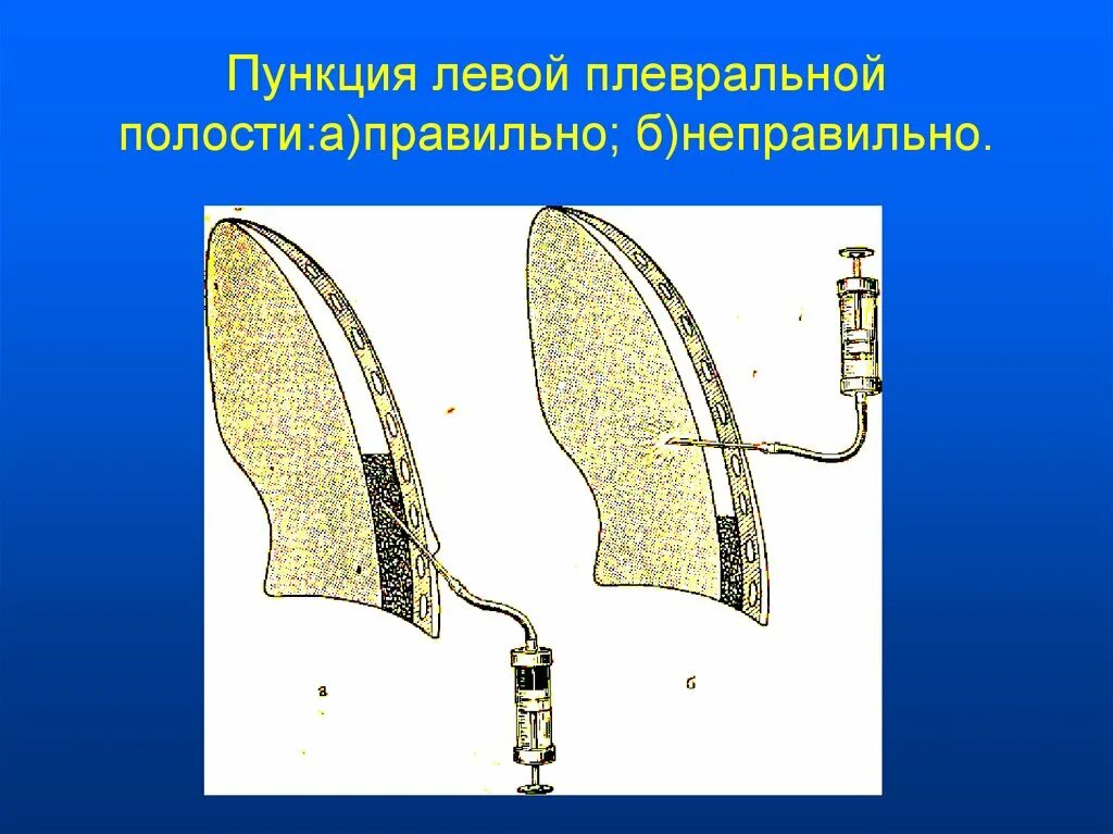 Пункция плевральной полости. Инструменты для плевральной пункции. Набор инструментов для пункции плевральной полости. Плевральная пункция оснащение.