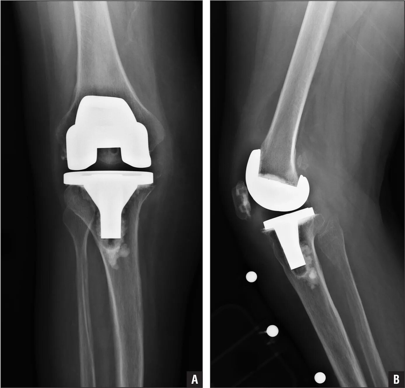 Эндопротез тазобедренного сустава москве. Тазобедренный эндопротез depuy. depuy эндопротезы тазобедренного сустава. эндопротез зиммер тазобедренного сустава рентген. коленный эндопротез stryker.