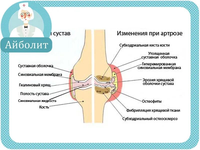 Артроз плечевого сустава мкб 10 у взрослых. Оболочки сустава. Артроз плечевого сустава мкб 10. Синовиальная оболочка колена. Костная жидкость.