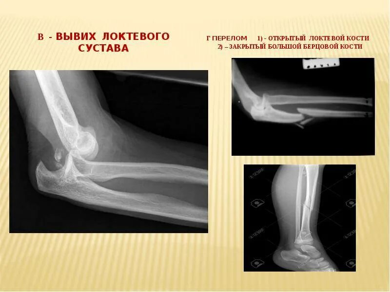 Перелом локтевой. Подвывих локтевого сустава рентген. вывих локтевого сустава рентген. локтевой сустав рентген перелом локтевого.