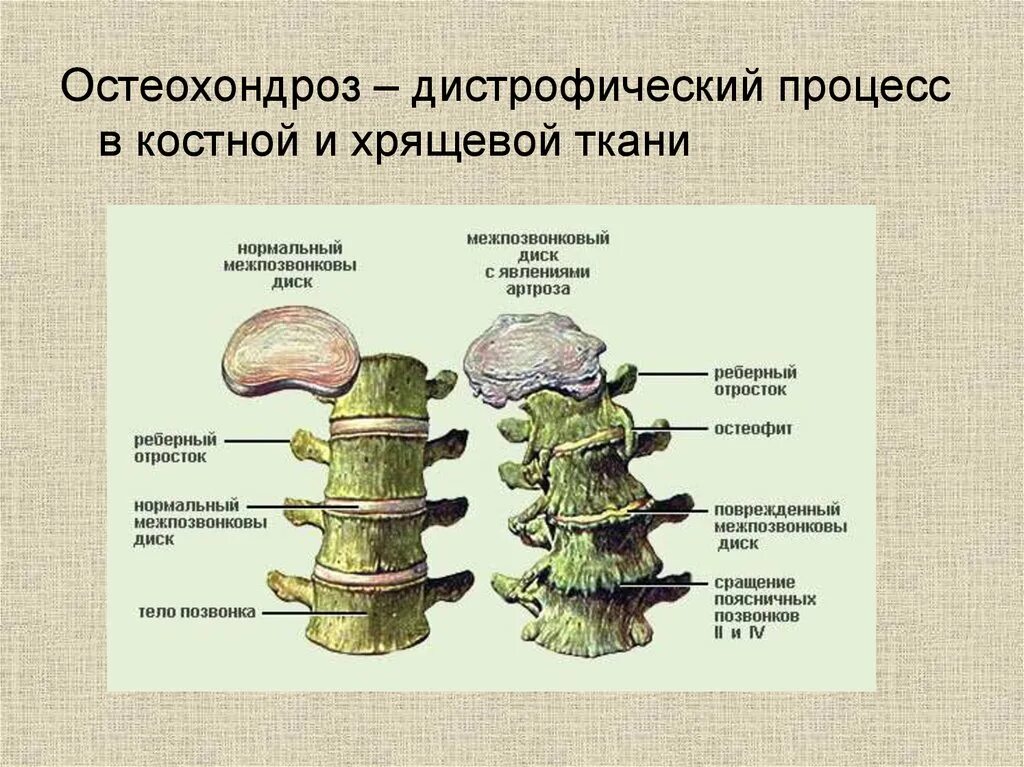 Костные структуры с дистрофическими изменениями