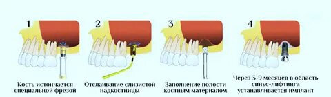 Синус в стоматологии это