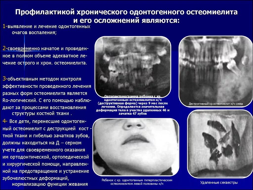 Заболевание нижней челюсти. Острый одонтогенный остеомиелит рентген. Острый одонтогенный остеомиелит челюсти симптомы. Одонтогенный остеомиелит челюсти рентген. Остеомиелит челюстных костей классификация.