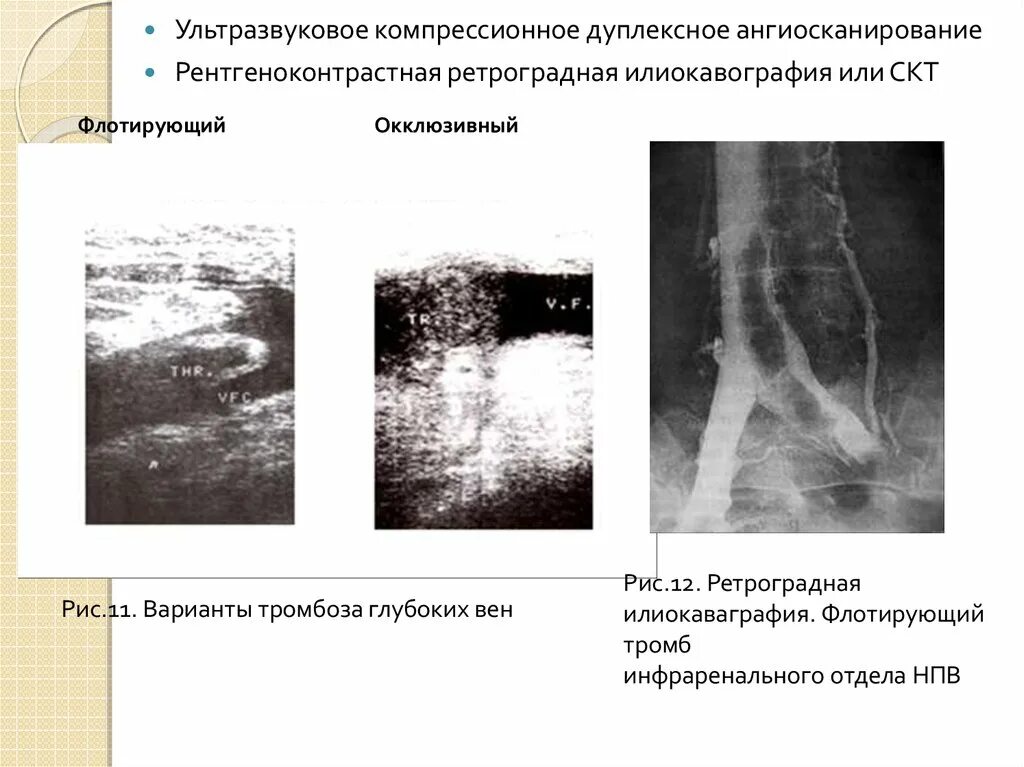 Тромбофлебит ультразвуковое дуплексное ангиосканирование.. Тромбоз глубоких вен флебография. Флотирующий тромб нижней полой вены. Тромбофлебит глубоких вен УЗИ. Окклюзионный тромбоз