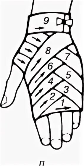 Техника наложения повязки перчатка