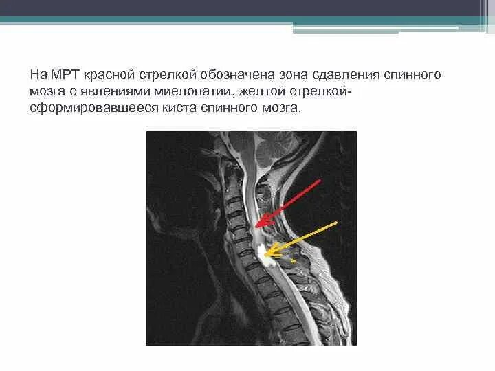 Сдавление спинного. Компрессионная миелопатия шейного отдела мрт. Миелопатия шейного отдела позвоночника мрт. Миелопатия спинного мозга мрт. Очаг миелопатии шейного отдела позвоночника.