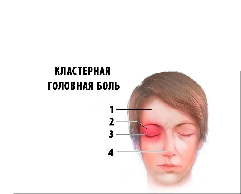 Индуцированная головная боль. Кластерные головные бо. Кластерная головная юоль. Кластернарная головная бошь. Кластерная головная боль симптомы.