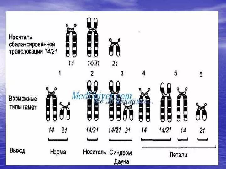 Носителем транслокации. Транслокация кариотип. робертсоновская транслокация 21. кариотип робертсоновской транслокации. транслокация хромосом.