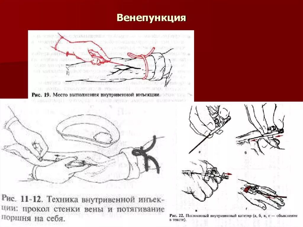 Внутривенно под каким углом. Венепункция и венесекция. Внутривенная инъекция алгоритм выполнения. Техника наложения жгута при внутривенной инъекции. Вены для внутривенной инъекции.