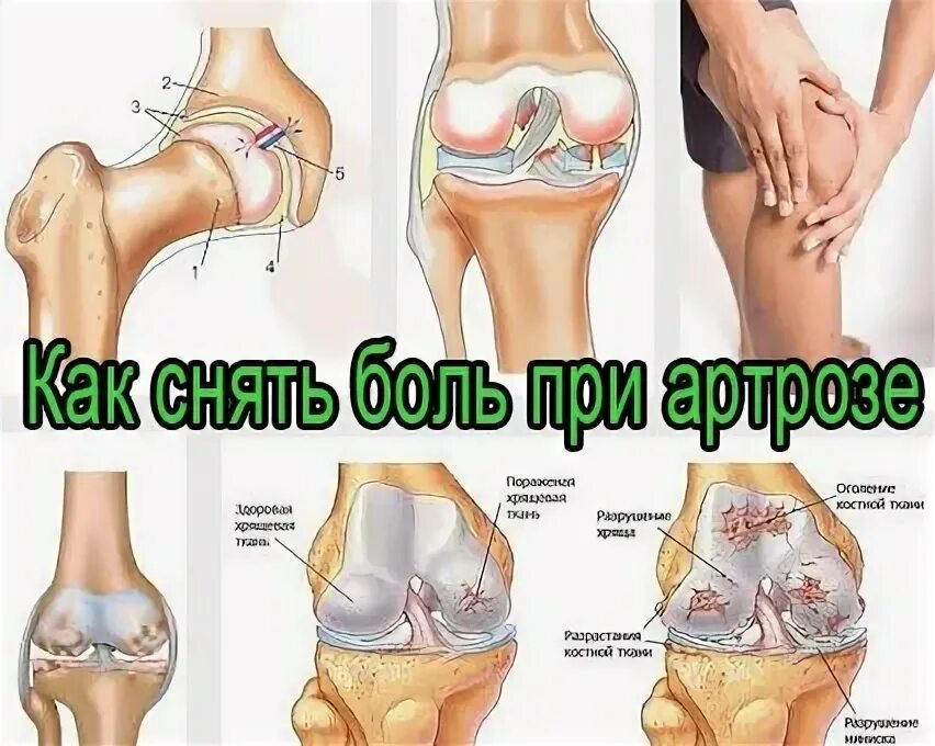 Таблетки для артроза коленного сустава. Снятие боли при артрозе. Восстановление суставов. Диета при артрозе суставов. Снятие боли при артрозе.