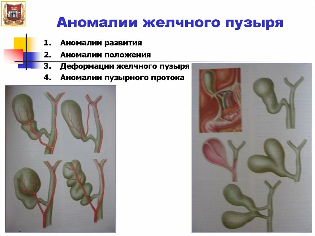 Изменение стенок желчного пузыря. Врожденная патология желчных протоков. аномалии развития желчных протоков. врожденные аномалии желчного пузыря. аномалии развития внепеченочных желчных протоков.
