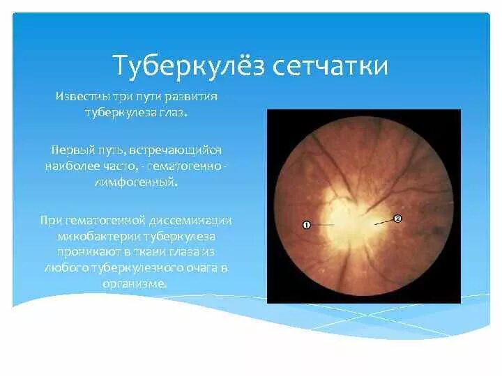 Как выглядит туберкулез глаз ➡ Иридоциклит. Симптомы, причины и лечение острого иридоциклита , лечение в Моск