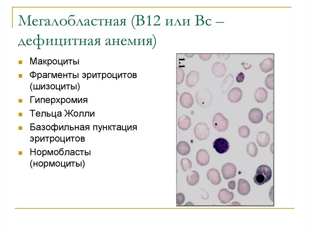 Пониженные макроциты. В12 анемия тельца Жолли. В12 мегалобластная анемия. В12 дефицитная анемия микропрепарат. Форма эритроцитов при в12 дефицитной анемии.