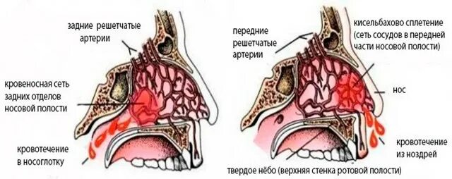 Как быстро снять отек слизистой Доврачебная неотложная помощь при острых аллергических реакциях