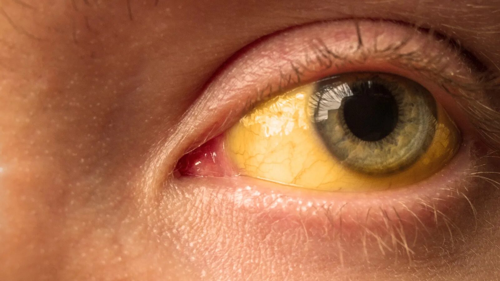 Желтые глаза конец. Иктеричность кожных склер.
