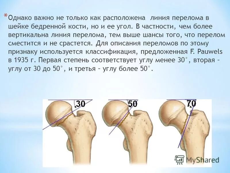 Перелом шейки бедра в пожилом возрасте