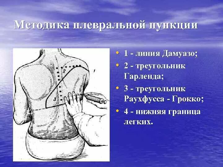 Техника выполнения плевральной пункции
