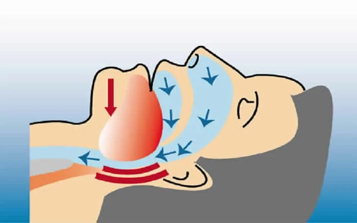 Как лечь чтобы не храпеть во сне. Поза для сна чтобы не храпеть. Гимнастика для языка от храпа. Массаж от храпа. Как лечь чтобы не храпеть во сне.