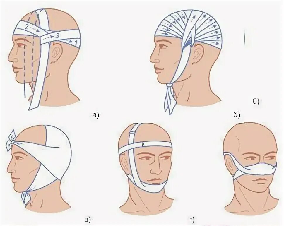 схема наложения повязки чепец. бинтование чепец. перевязка головы бинтом чепец. десмургия чепец. повязка при травме головы черепец.