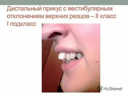 Прикус 1
