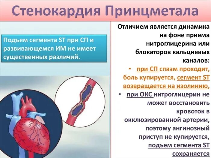 Сердце при стенокардии. Ибс вариантная стенокардия принцметала. Стеноз коронарных артерий симптомы. Ибс нестабильная стенокардия. Экг критерии стенокардии принцметала.