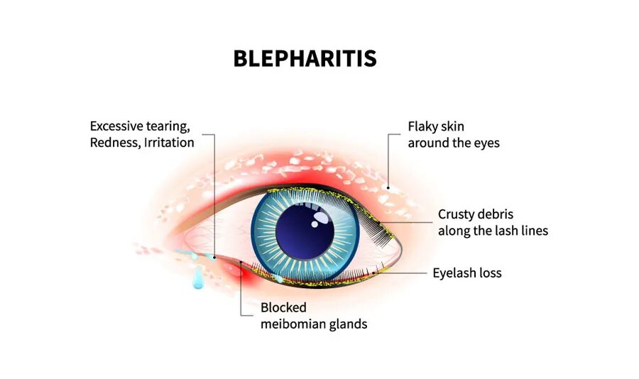 Зона глаз. Blepharitis перевод с латинского.