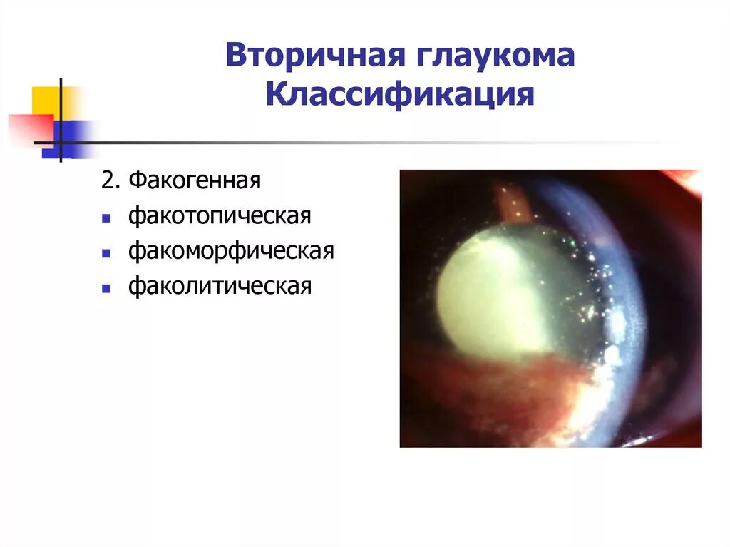 Факолитическая глаукома. Факоморфическая катаракта. Вторичная факогенная глаукома. Классификация глаукомы