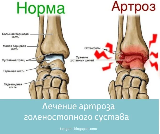 Артроз голеностопного сустава 3 степени. Посттравматический деформирующий артроз голеностопного сустава. Крузартроз голеностопного сустава степени. Гиалиновый хрящ голеностопного сустава.