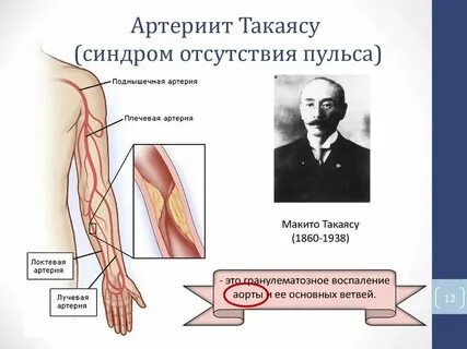 Болезнь такаясу клинические рекомендации