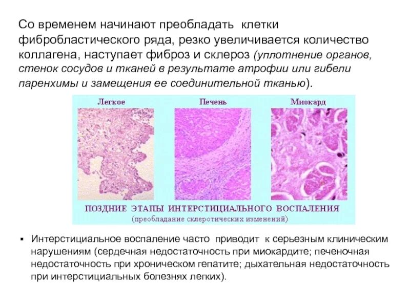 Фиброз после ковида. Склероз и фиброз отличия. Отличие фиброза от склероза. Склероз патологическая анатомия.