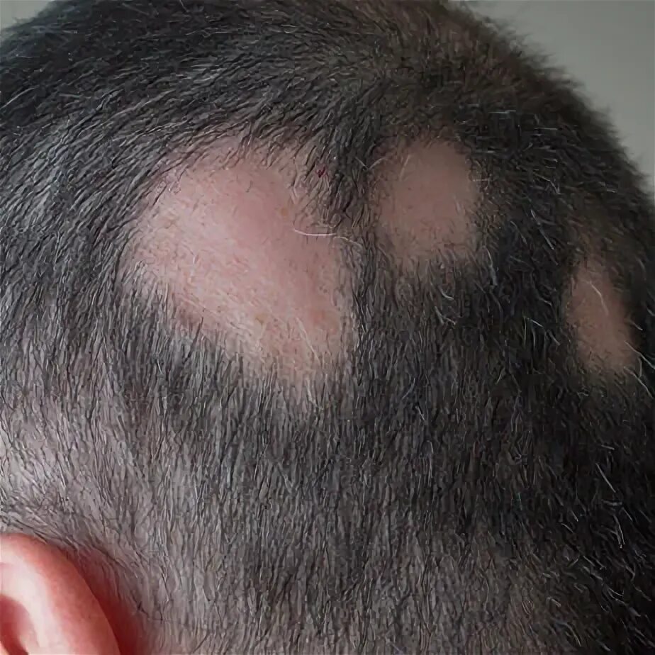Залысины на голове. Сонник облысение. Сниться лысина на голове. Hair loss. Сонник облысение.