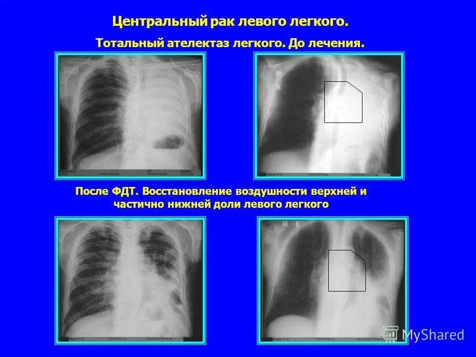уентральныйрак легкого. гиповентиляция легких на рентгенограмме. ателектаз верхней доли правого легкого на рентгене. ателектаз верхней доли левого легкого. центральная опухоль легкого.