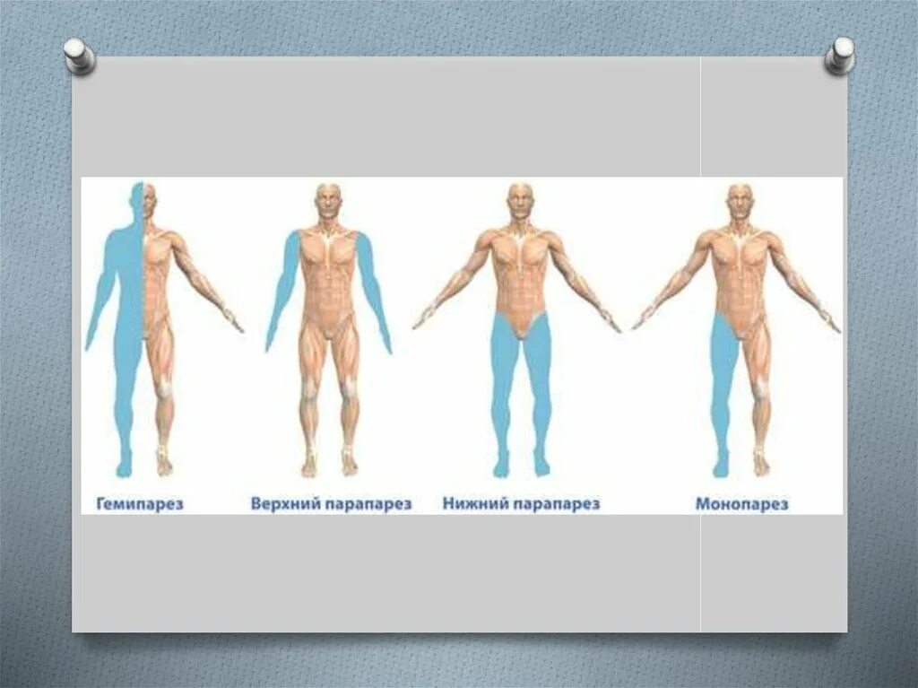 Монопарез. Левосторонний монопарез. Гемипарез монопарез. Гемипарез лечение