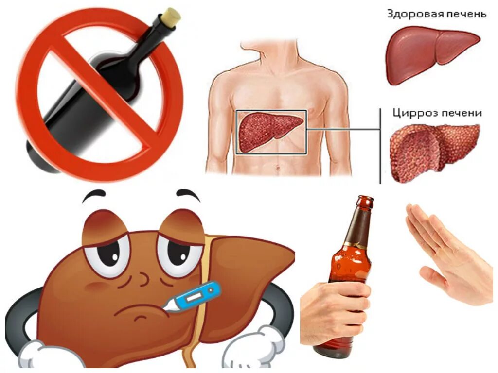 Алкогольный цирроз симптомы у мужчин. Алкогольный гепатит и цирроз. Алкогольные заболевания печени. Профилактика алкогольного гепатита.
