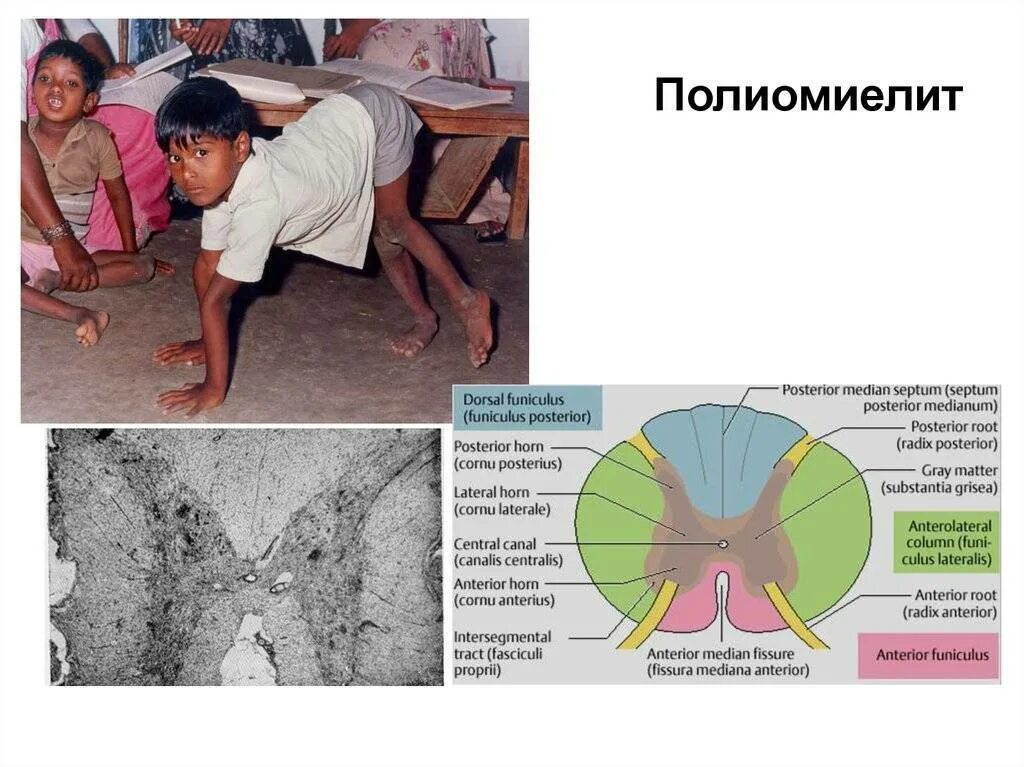 Полиомиелит это простыми словами. Клинические симптомы полиомиелита. Полиомиелит проявления болезни. Паралитический полиомиелит.