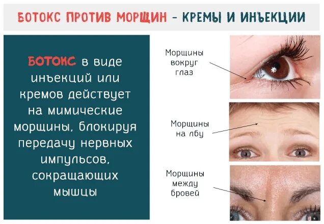 Через сколько действует ботокс после инъекций. Инъекции ботокса вокруг глаз. ботокс русский аналог. аналог ботокса для лица.
