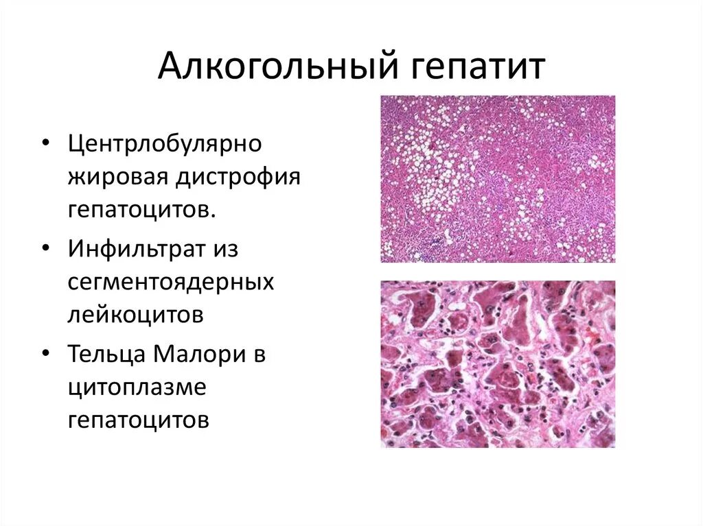 Алкогольная жировая болезнь. Алкогольный гепатит тельца Маллори. Острый алкогольный гепатит микропрепарат. Формы алкогольного гепатита. Острый и хронический алкогольный гепатит.