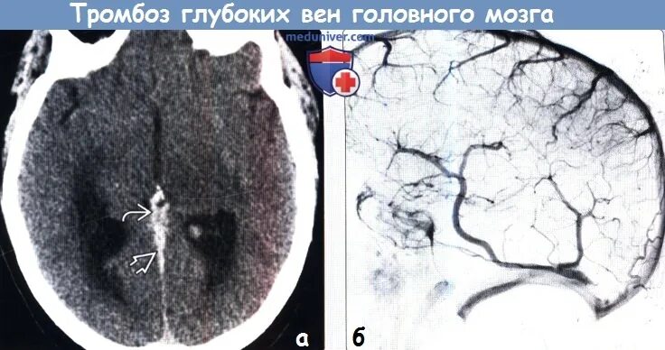 Тромбоз Вена Галена кт. Тромбоз вен головного мозга кт. Тромбоз венозного синуса на кт. Тромбоз венозного синуса головного мозга кт. Тромбоз на кт