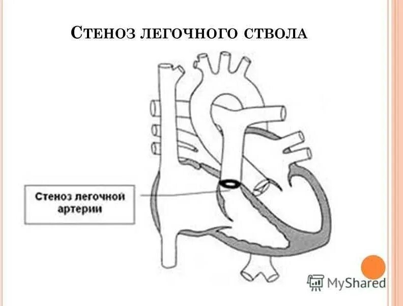 Впс изолированный стеноз легочной артерии. Стеноз легочной артерии схема. Трикуспидальный клапан стеноз гемодинамика. Гемодинамика. Пороки сердца стеноз клапана легочной артерии.