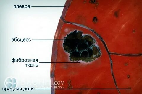 Острый гнойный абсцесс