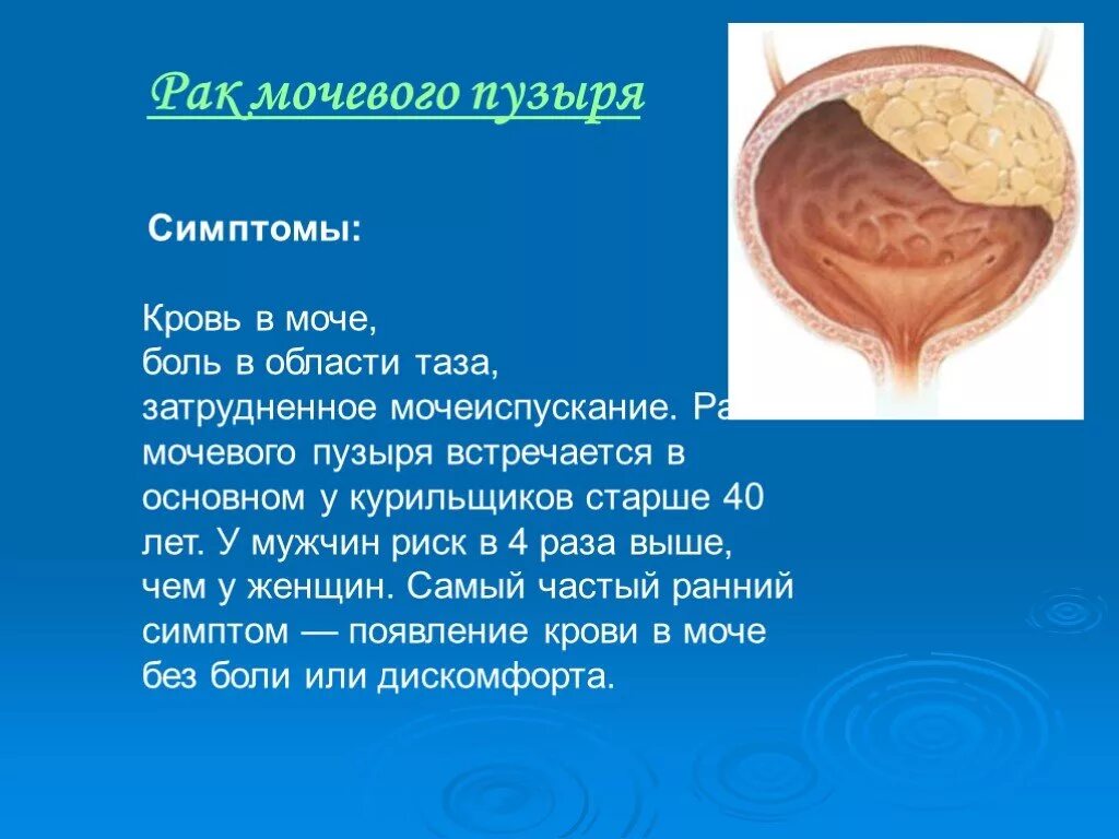 Заболевания мочевого пузыря. Болезни мочевого пузыря у женщин. Опухолевые заболевания мочевого пузыря. Мочевой пузырь болезни симптомы.