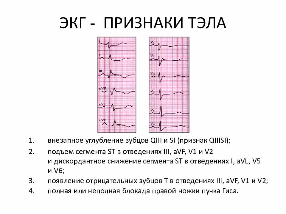 Тромбоэмболия легочной артерии экг. Признаки Тэла на ЭКГ. Изменения на ЭКГ при Тэла. ЭКГ при тромбоэмболии легочной артерии. ЭКГ критерии Тэла.