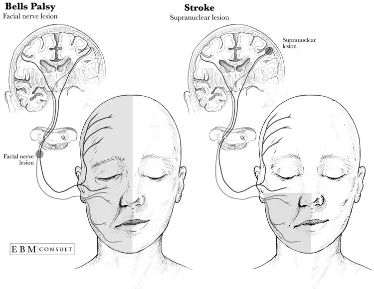 Центральный и периферический парез лицевого нерва неврология. Паралич лицевого нерва дифференциальная диагностика. Центральный парез лицевого нерва поражение.